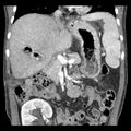 Biliary necrosis - liver transplant (Radiopaedia 21876-21846 C 23).jpg