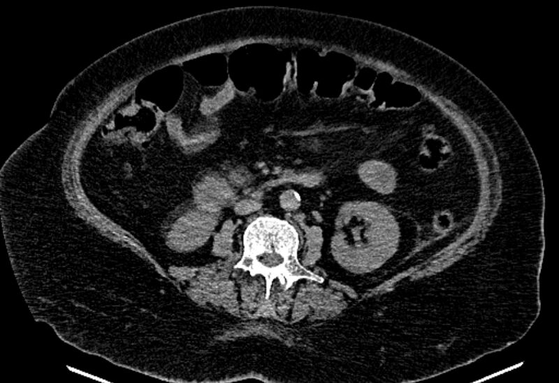 File:Biliary pancreatitis (Radiopaedia 72289-82823 Axial non-contrast 136).jpg