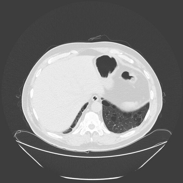 File:Birt-Hogg-Dubé syndrome (Radiopaedia 52578-58491 Axial lung window 55).jpg