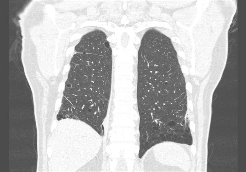 File:Birt-Hogg-Dubé syndrome (Radiopaedia 52578-58491 Coronal lung window 50).jpg