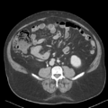 Bladder papillary urothelial carcinoma (Radiopaedia 48119-52951 Axial 31).png