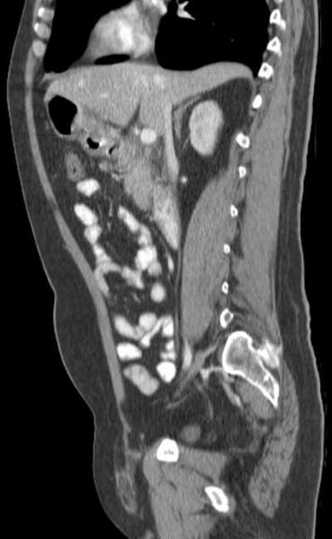 File:Bleeding duodenal ulcer and adenomyomatosis of gallbladder (Radiopaedia 61834-69861 C 41).jpg