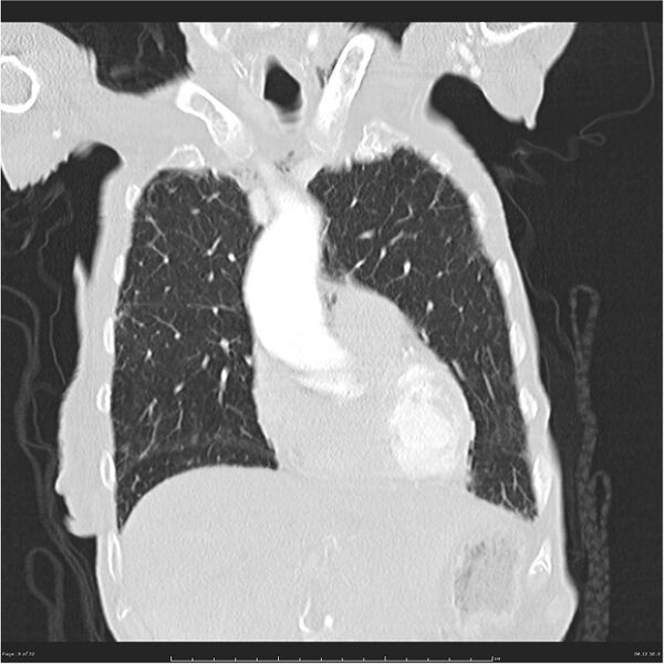 File:Boerhaave syndrome (Radiopaedia 26240-26362 Coronal lung window 8).jpg