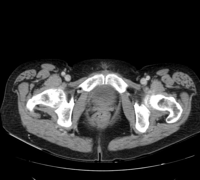 File:Bosniak renal cyst - type IV (Radiopaedia 22929-22953 C 68).jpg