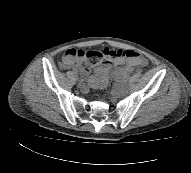 File:Bowel lymphoma complicated by bleeding after therapy (Radiopaedia 55601-62110 Axial non-contrast 66).jpg