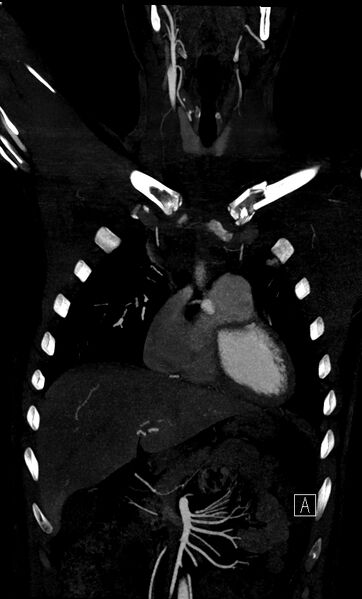 File:Brachiocephalic trunk pseudoaneurysm (Radiopaedia 70978-81191 B 22).jpg