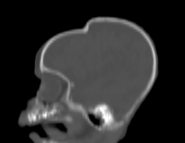 File:Brachycephaly (bi-coronal and bi-lambdoid synostosis) (Radiopaedia 55048-61413 Sagittal bone window 10).jpg