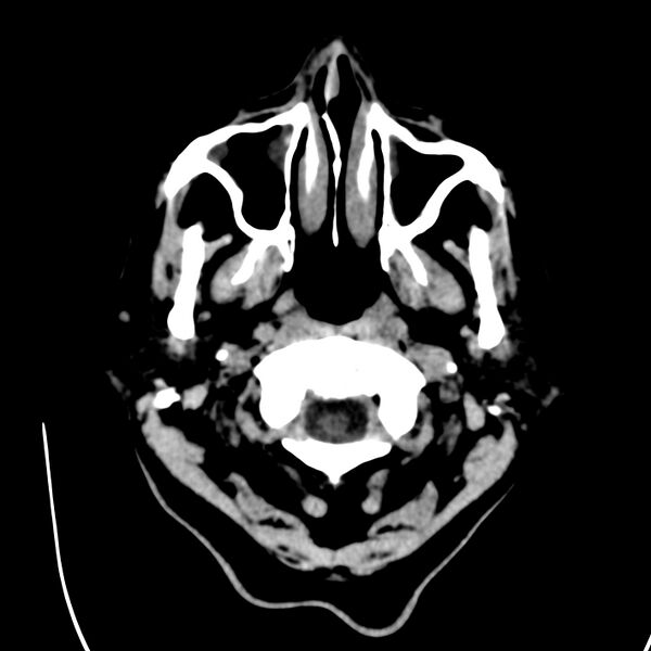 File:Brain Pantopaque remnants (Radiopaedia 78403-91048 Axial non-contrast 11).jpg