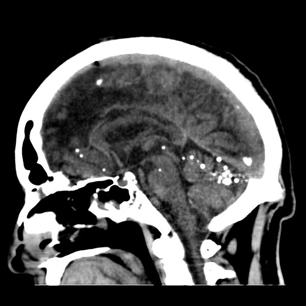File:Brain Pantopaque remnants (Radiopaedia 78403-91048 C 29).jpg