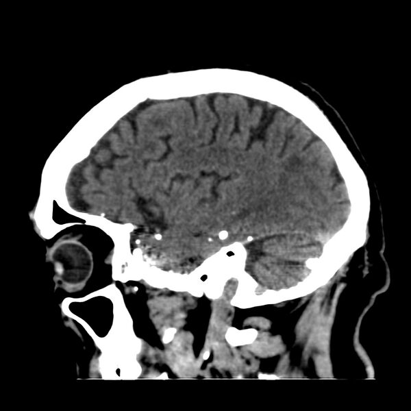 File:Brain Pantopaque remnants (Radiopaedia 78403-91048 C 42).jpg