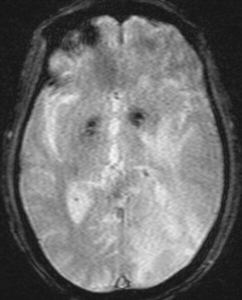 File:Brain abscess with dual rim sign (Radiopaedia 87566-103938 Axial SWI 11).jpg