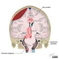 Brain herniation types (Radiopaedia 45683-49865 D 1).jpg