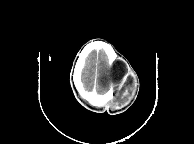 File:Brain injury by firearm projectile (Radiopaedia 82068-96088 B 184).jpg