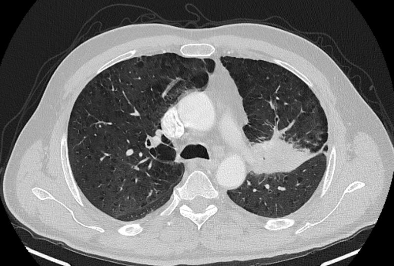 File:Brain metastases - lung cancer primary (Radiopaedia 75060-86116 Axial lung window 20).jpg