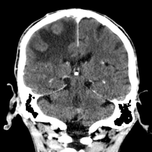 File:Brain metastases from lung cancer (Radiopaedia 27849-28092 Coronal C+ delayed 41).jpg