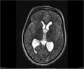 Brainstem glioma (Radiopaedia 21819-21775 Axial T2 20).jpg