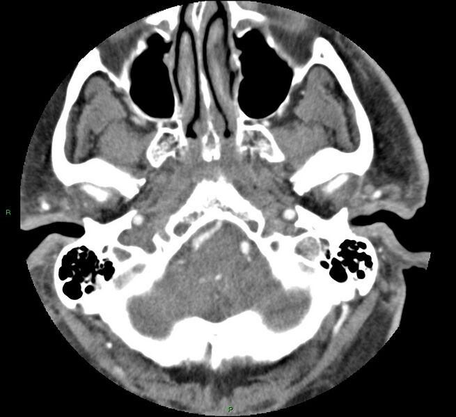 File:Brainstem hemorrhage (Radiopaedia 58794-66028 D 30).jpg