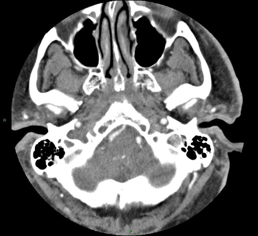 Brainstem hemorrhage (Radiopaedia 58794-66028 D 30).jpg