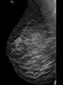 Breast within a breast sign - hamartoma (Radiopaedia 64005-72757 MLO - Tomosynthesis 1).JPG