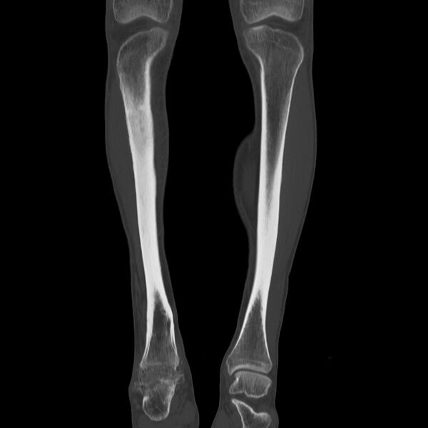 File:Brodie abscess - tibia (Radiopaedia 66028-75204 Coronal bone window 12).jpg