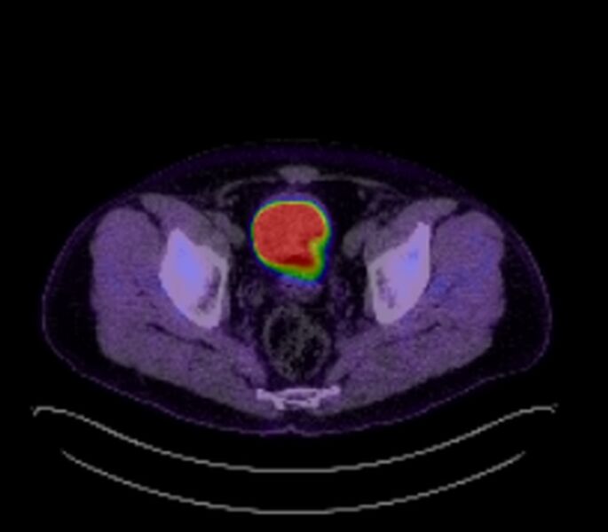 File:Bronchial carcinoid tumor (Radiopaedia 67377-76766 18FDG-PET-CT 57).jpg