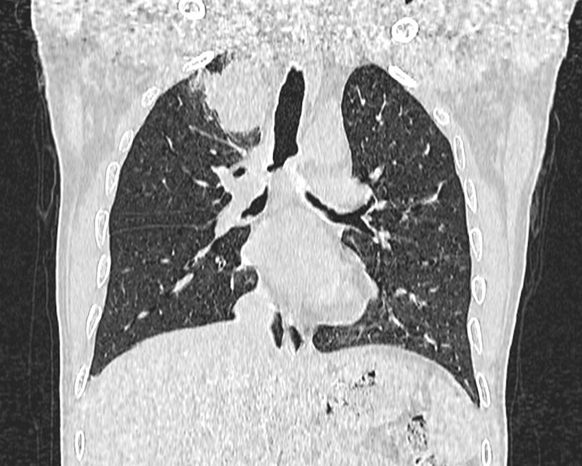 Bronchogenic carcinoma with superior vena cava syndrome (Radiopaedia 36497-38054 Coronal lung window 40).jpg