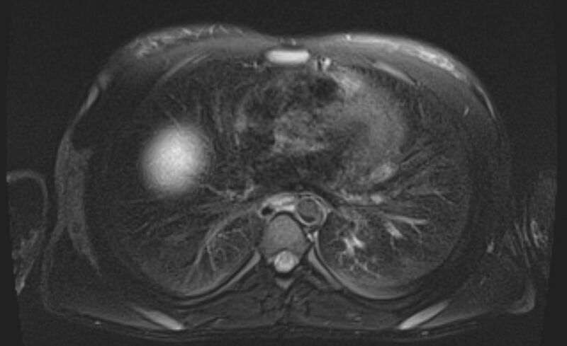 File:Budd Chiari syndrome (Radiopaedia 70299-80375 Axial T2 fat sat 1).jpg