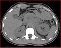 Burned-out testicular choriocarcinoma (Radiopaedia 32822-34040 Axial non-contrast 5).jpg