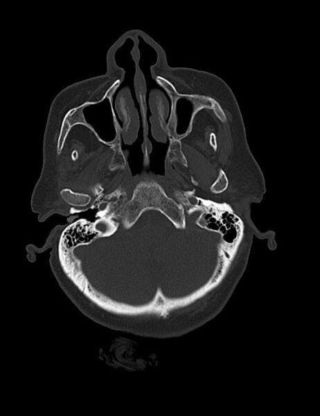 File:Burnt-out meningioma (Radiopaedia 51557-57337 Axial bone window 7).jpg