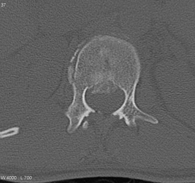 File:Burst fracture (Radiopaedia 5274-7018 Axial bone window 6).jpg