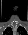 Butterfly vertebra (Radiopaedia 77903-90209 Coronal bone window 65).jpg