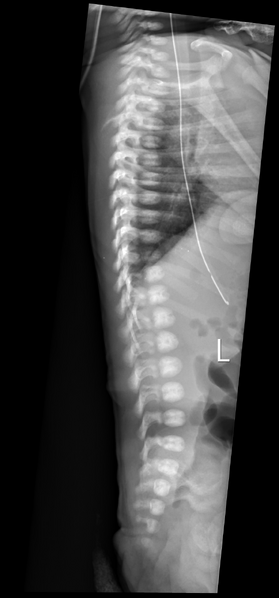 File:Butterfly vertebra and anal atresia (Radiopaedia 26084-26220 Lateral 1).png