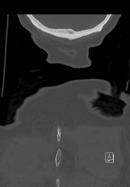 File:C1 and C2 (peg) fractures (Radiopaedia 36618-38184 Coronal bone window 60).jpg