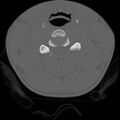 C5 facet fracture (Radiopaedia 58374-65499 Axial bone window 40).jpg