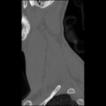 C5 facet fracture (Radiopaedia 58374-65499 Sagittal bone window 61).jpg