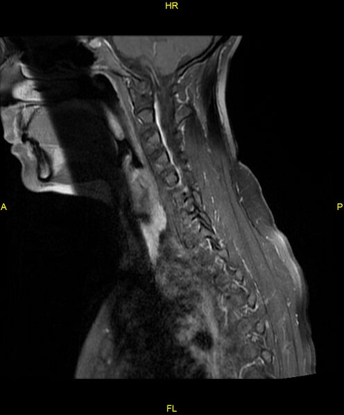 File:C5 nerve sheath tumor (Radiopaedia 85777-101596 F 13).jpg