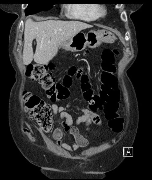 File:Calcified adrenal glands and Spigelian hernia (Radiopaedia 49741-54988 B 26).jpg