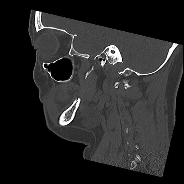 File:Canal up mastoidectomy (Radiopaedia 78108-90638 Sagittal bone window 21).jpg