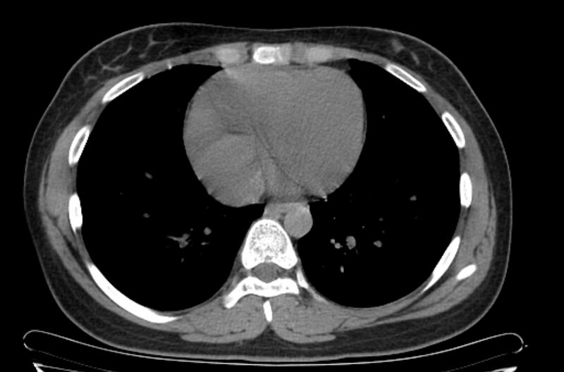 File:Cannonball metastases - uterine choriocarcinoma (Radiopaedia 70137-80173 Axial non-contrast 83).jpg