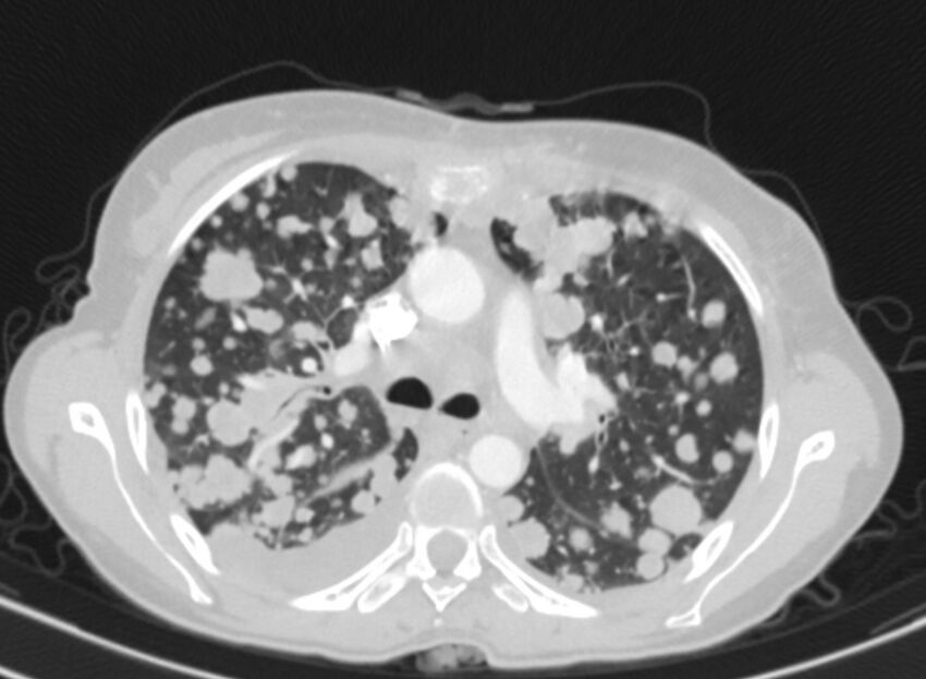 Cannonball metastases from breast cancer (Radiopaedia 91024-108569 Axial lung window 34).jpg