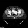 Carcinoma cervix- recurrence (Radiopaedia 34702-36137 B 86).jpg