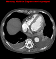 Cardiac perforation following transcatheter aortic valve implantation (Radiopaedia 23714-23863 A 11).png