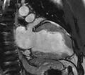 Cardiac sarcoidosis (Radiopaedia 39811-42243 B 15).jpg