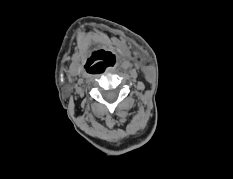 File:Carotid artery pseudoaneurysm (Radiopaedia 84030-99259 Axial non-contrast 14).jpg