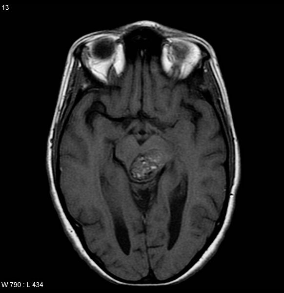 File:Cavernous malformation of the midbrain (Radiopaedia 7791-8615 Axial T1 2).jpg
