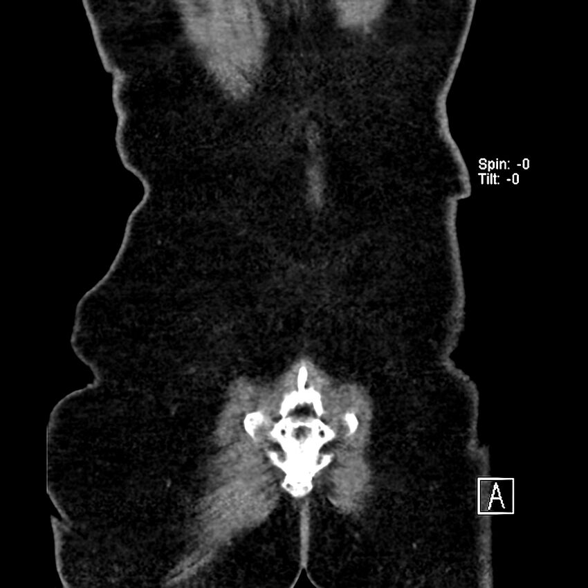 Cecal volvulus (Radiopaedia 90897-108397 Coronal non-contrast 3).jpg