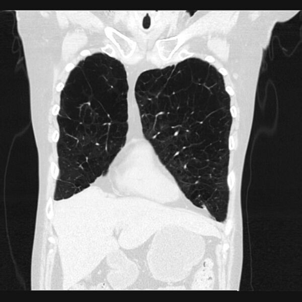 File:Centrilobular pulmonary emphysema (Radiopaedia 24495-24789 Coronal lung window 16).jpg