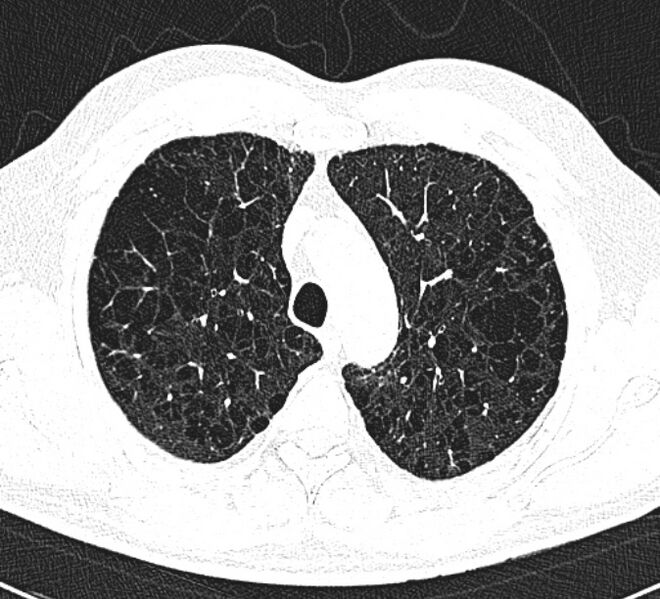 File:Centrilobular pulmonary emphysema (Radiopaedia 26808-26971 Axial lung window 10).jpg