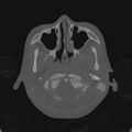 Cerebellar abscess secondary to mastoiditis (Radiopaedia 26284-26413 Axial bone window 14).jpg
