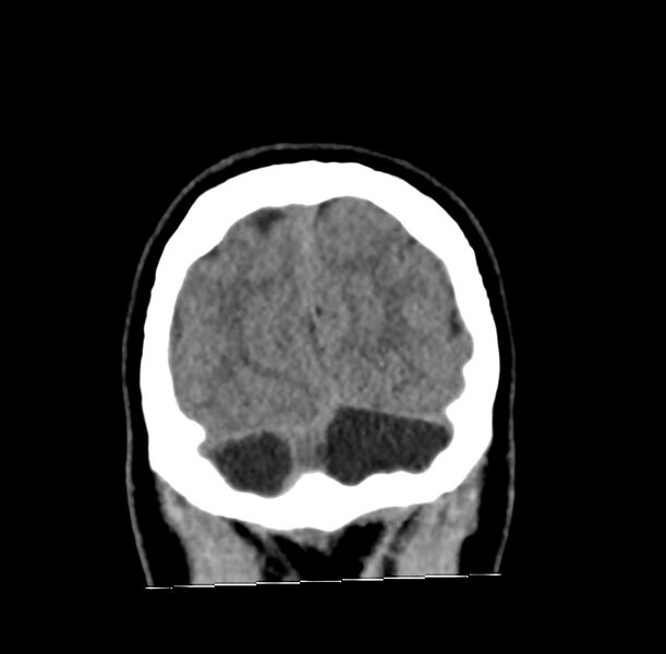File:Cerebellar agenesis (Radiopaedia 30203-30817 Coronal non-contrast 45).jpg